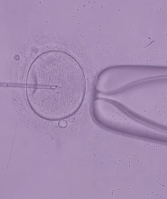 Encino IVF Investigational Study